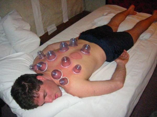 Hijama - Cupping Hijama - Cupping